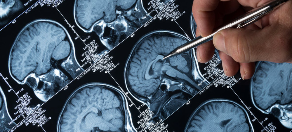 The Promise of a New Alzheimer's Drug