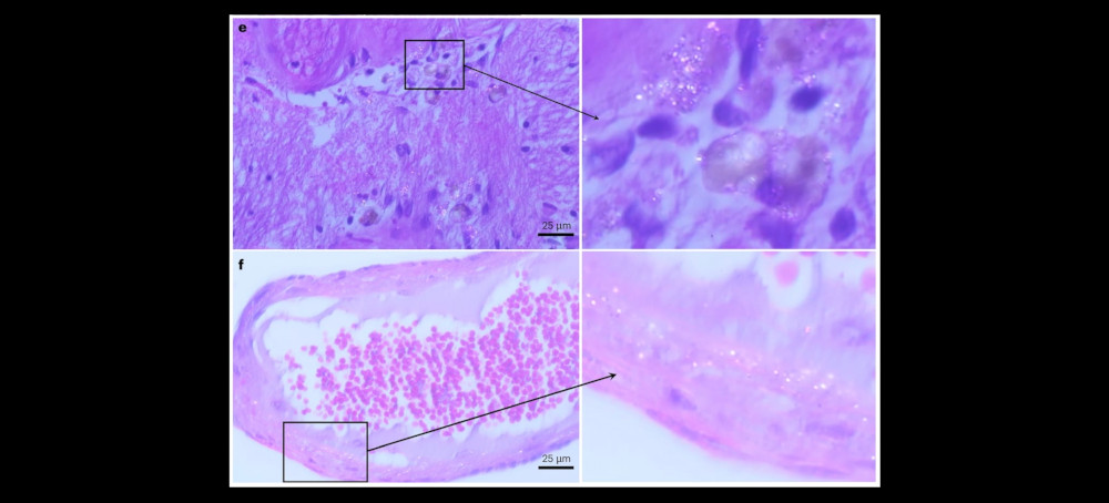 Study: Accumulation of Microplastics in Human Brain Tissue Rising Rapidly